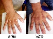手背白癜风治疗前后对比