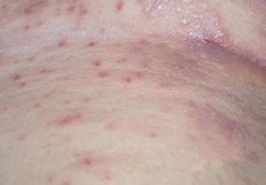 产生湿疹的原因是什么