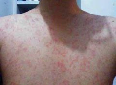 夏季荨麻疹预防小方法