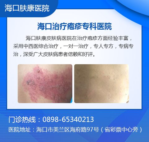 海口看带状疱疹哪个医院好