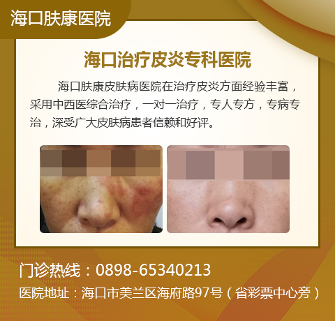 海口哪个医院治疗皮炎专业