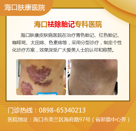 激光去胎记要多少钱呢?
