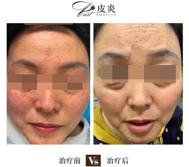 海口看皮炎的哪家医院好