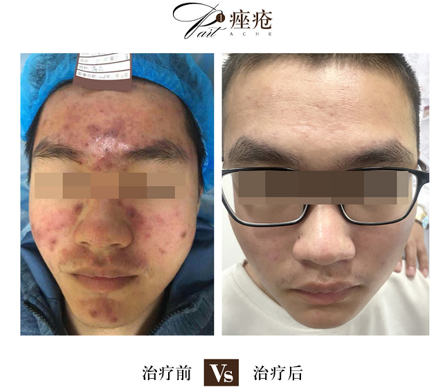 海口青春痘哪家医院好点