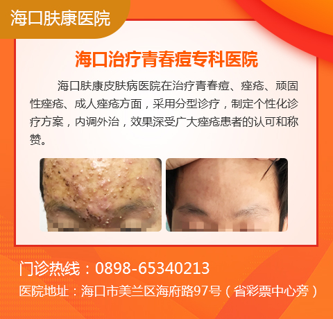 海口专业治疗青春痘的医院