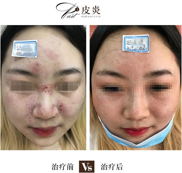 中医治疗皮肤过敏海口