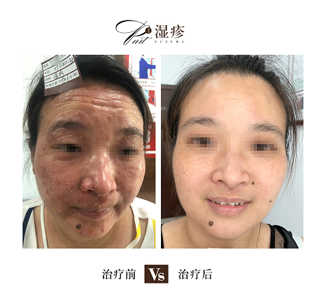 日常生活中要避开这些让湿疹反复发作的因素