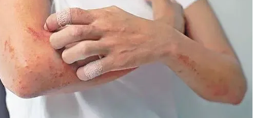 海南皮肤科专科医院湿疹