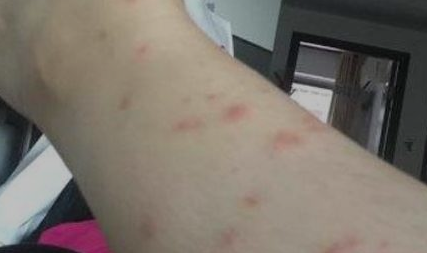治荨麻疹哪个医院好海口市