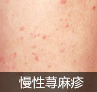海南看荨麻疹哪家医院好
