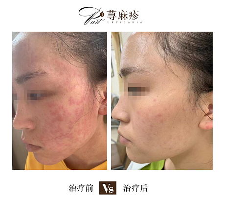 海南治疗荨麻疹的医院