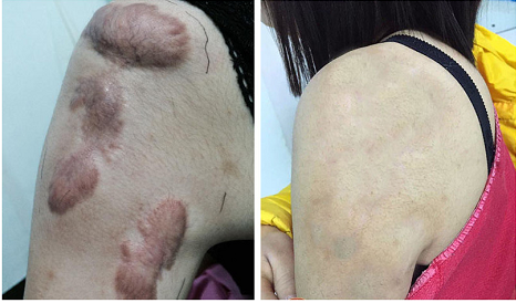 海口疤痕修复哪家医院好
