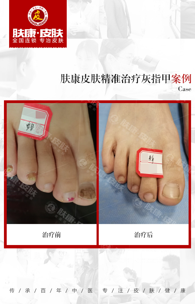 治疗灰指甲好的海口医院