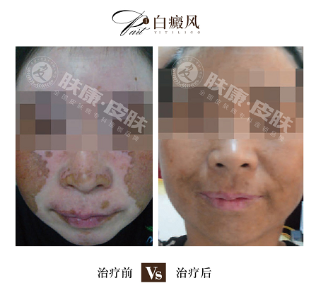 白癜风是什么原因造成的_海口白癜风医院皮肤科