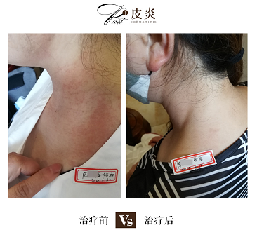 海口哪个治疗皮肤过敏较好