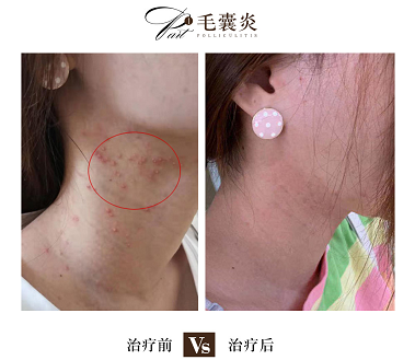 海口皮肤医生:细菌感染毛囊炎怎么处理?
