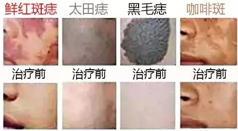 海口去胎记的医院哪里好