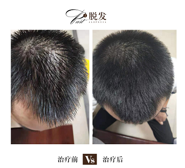海口哪里有看脱发的