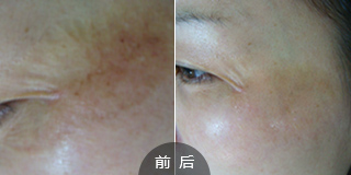 海口哪家医院去除疤痕好