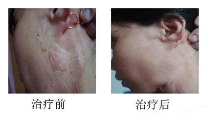 疤痕做修复的时候要注意出现以下几个症状-海口皮肤医生